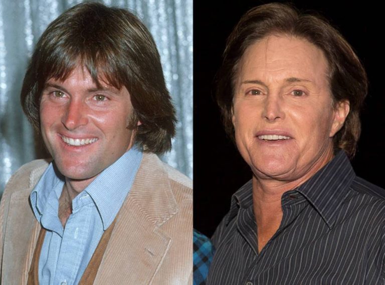 Bruce Jenner Before and After Plastic Surgery Photos Reveal More than