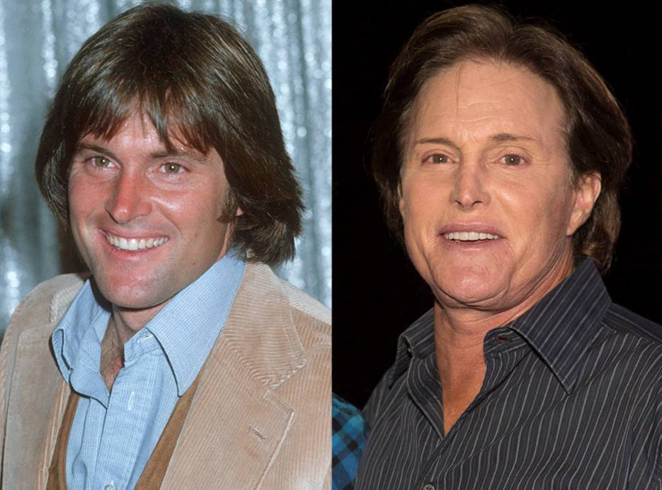 Bruce Jenner Before and After Plastic Surgery Photos Reveal More than ...