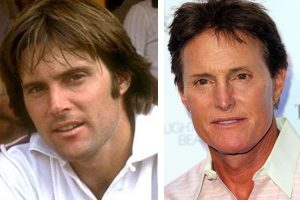 Bruce Jenner Before and After Plastic Surgery Photos Reveal More than